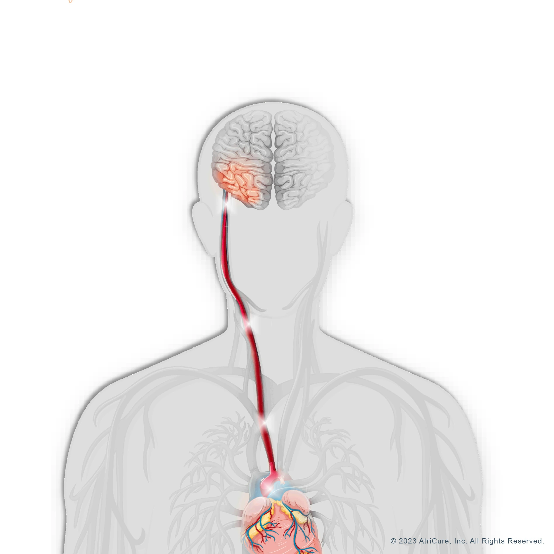 Heart Brain Connection - Stroke (JPG)