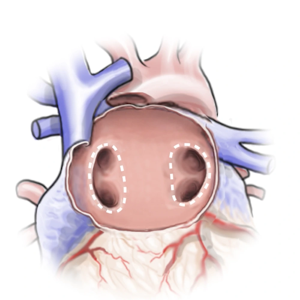 Heart Endocardial (JPG)