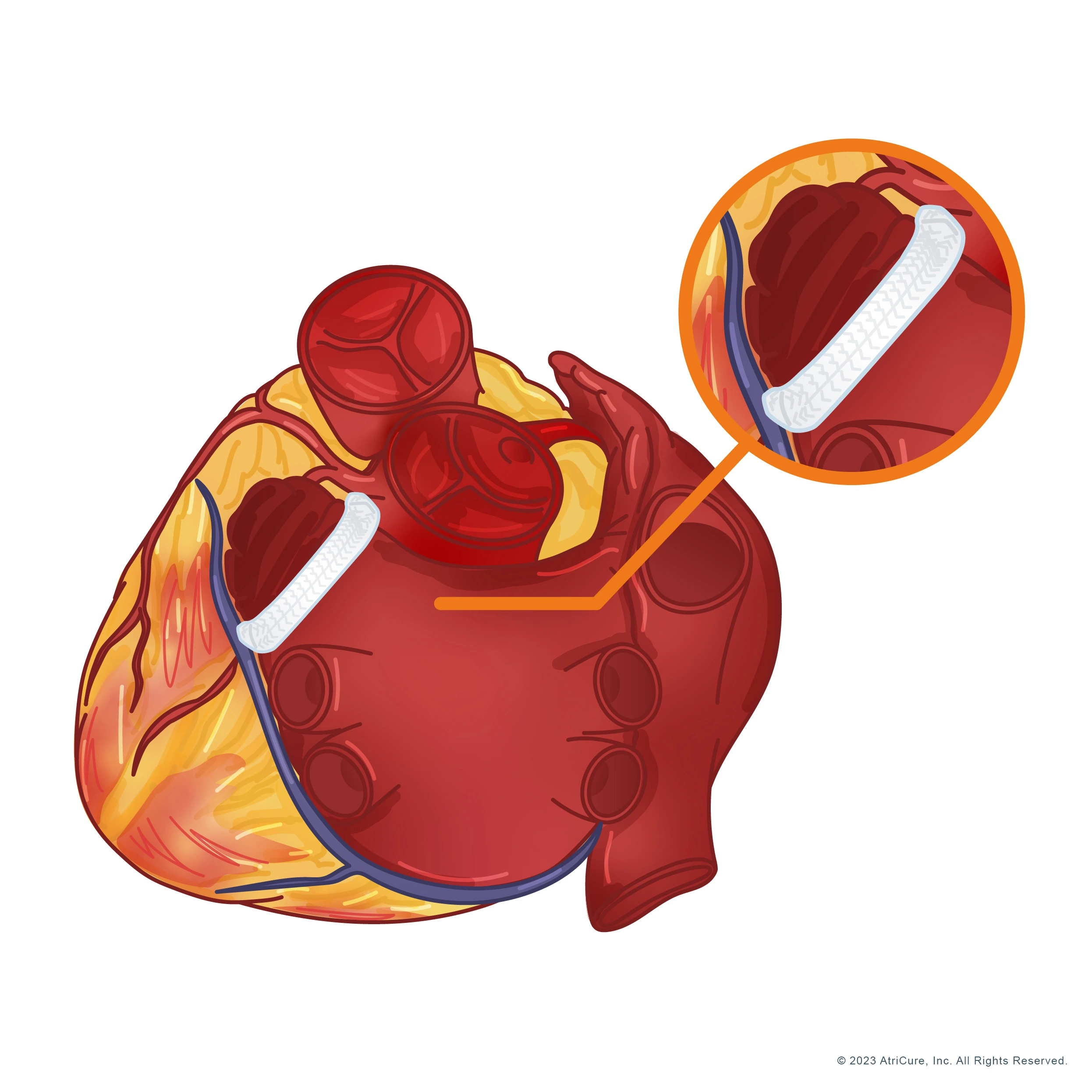 Left Atrial Appendage Management - Heart (JPG)
