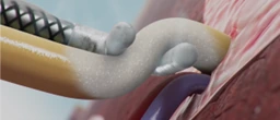 cryo nerve block amputation