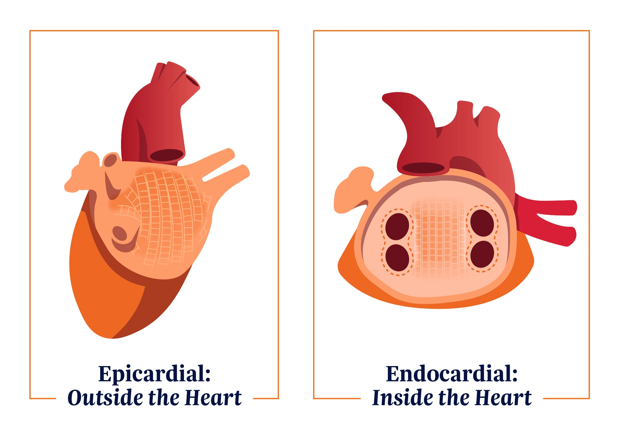 Heart Epicardial and Endocardial