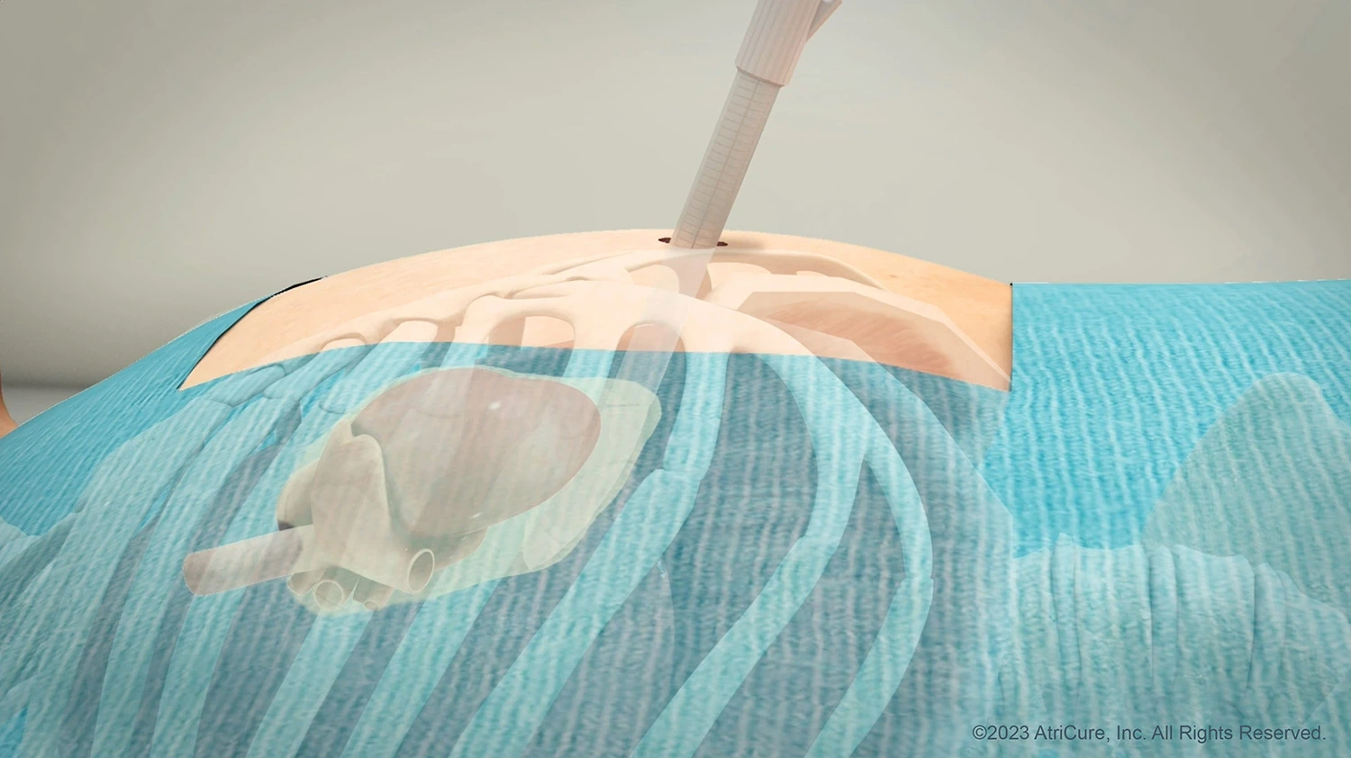 Convergent Approach Subxiphoid - side (JPG)