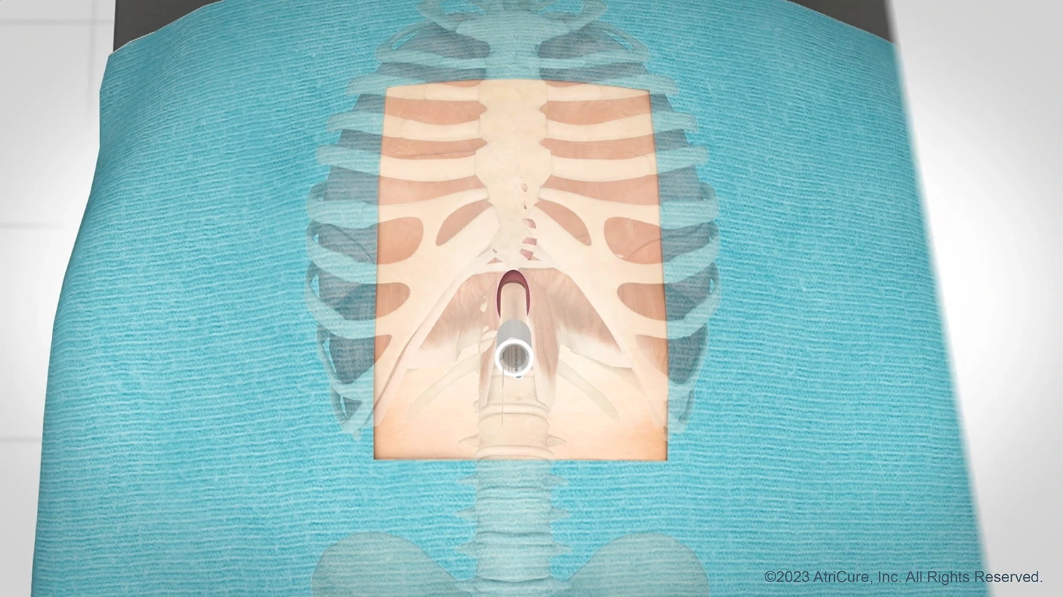 Convergent Approach Subxiphoid - above (JPG)