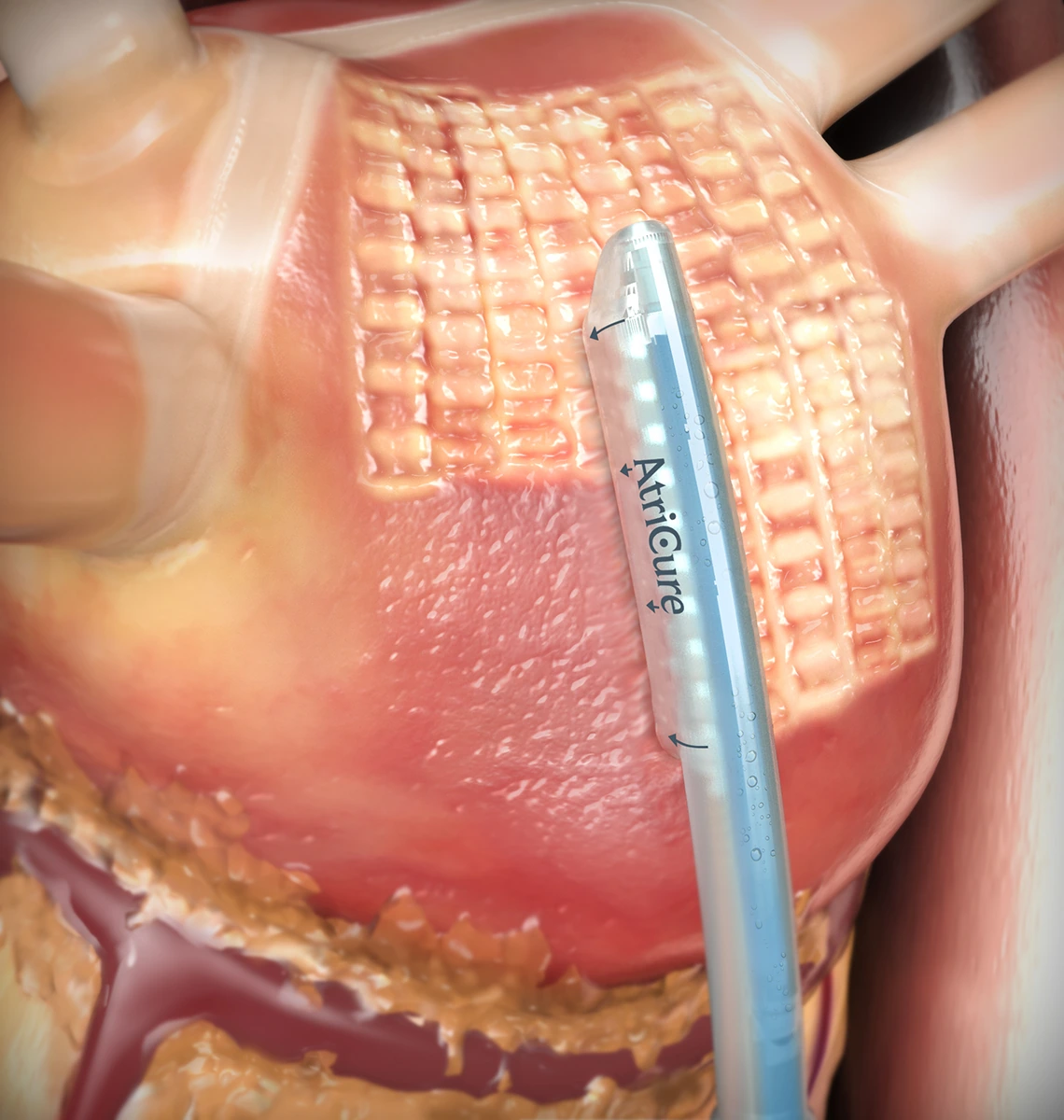 Hybrid AF Therapy with EPi-Sense Device (JPG)